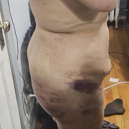 This is 3 days post-op "BBL"