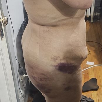 Mia Aesthetics Chicago - This is 3 days post-op "BBL" - Plastic Surgeons Near Me - Chicago, Illinois