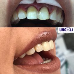 Uncali Dental Clinic - Porcelain veneers