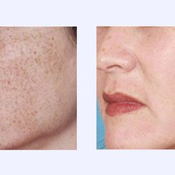 De La Belle Wellness & Spa - ELOS PLUS IPL LASER FOR SUN DAMAGE REMOVAL!