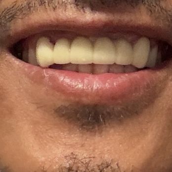 Cedar Smiles Dentistry - Here is after - General Dentistry Near Me - Bellflower, California