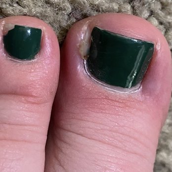 Happiness Nails & Spa - Infection on toe from pedicure - Nail Salons Near Me - Visalia, California Happiness Nails & Spa - Infection on toe from pedicure - Nail Salons Near Me - Visalia, California