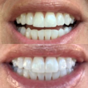 Starr Smiles - White teeth in an hour! - Teeth Whitening Near Me Starr Smiles - White teeth in an hour! - Teeth Whitening Near Me