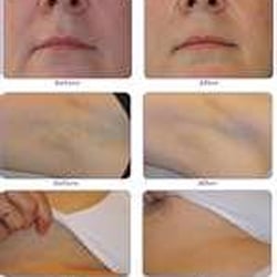 The Martin Center - pain free laser hair removal