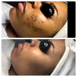 Acne Specialists of Nashville