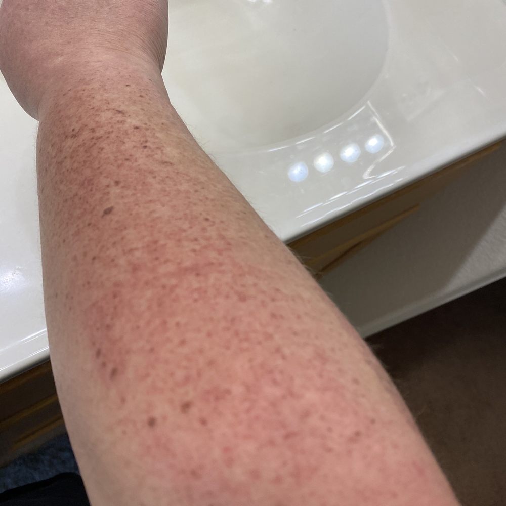 Eternal Skinshine - First treatment photo see all the brown spots! These all faded away like magic! - Skin Care Near Me - Beverly Hills, California Eternal Skinshine - First treatment photo see all the brown spots! These all faded away like magic! - Skin Care Near Me - Beverly Hills, California