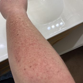 Eternal Skinshine - First treatment photo see all the brown spots! These all faded away like magic! - Skin Care Near Me - Beverly Hills, California Eternal Skinshine - First treatment photo see all the brown spots! These all faded away like magic! - Skin Care Near Me - Beverly Hills, California