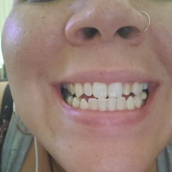 Michelsen Dental - Before - General Dentistry Near Me - Orange, California Michelsen Dental - Before - General Dentistry Near Me - Orange, California