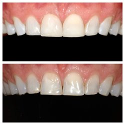 Union Square Dental Practice - Chairside composite veneers