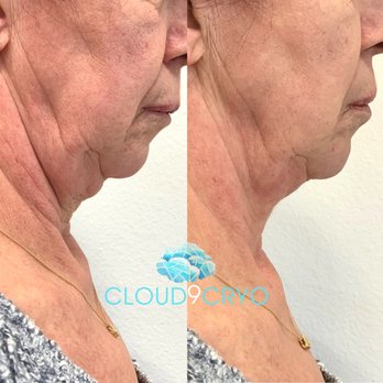 Cloud9Cryo - Before & After first Cryo T-Shock Toning on her neck. - Cryotherapy Near Me - Long Beach, California
