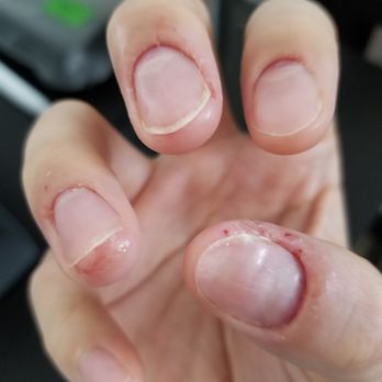 Lashlabnyc - What she needed to deal with: my right hand with eczema, and bumpy nails. - Eyelash Service Near Me - Flushing, New York