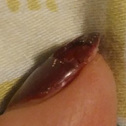 3 visits with chips n peeling within 24- 36 hours