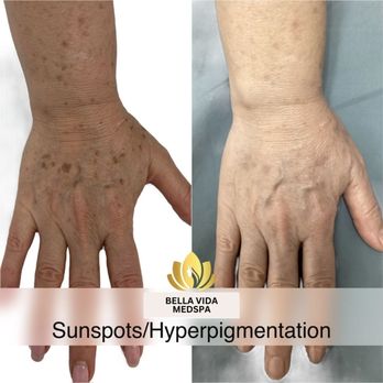 Bella Vida Medspa - Before and after 2 sunspot/benign hyperpigmentation laser treatments and Alastin medical grade skincare - Medical Spas Near Me - Temecula, California Bella Vida Medspa - Before and after 2 sunspot/benign hyperpigmentation laser treatments and Alastin medical grade skincare - Medical Spas Near Me - Temecula, California