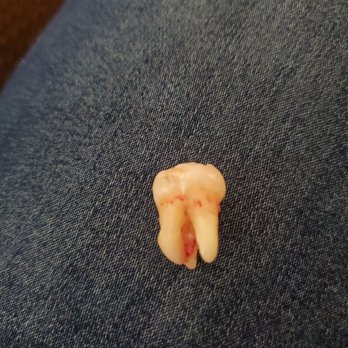 Placentia Oral Surgery - This is my tooth I had pulled - Oral Surgeons Near Me - Placentia, California