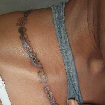 Gold n Glo Aesthetics - Over a month later - Laser Hair Removal Near Me - San Jose, California Gold n Glo Aesthetics - Over a month later - Laser Hair Removal Near Me - San Jose, California