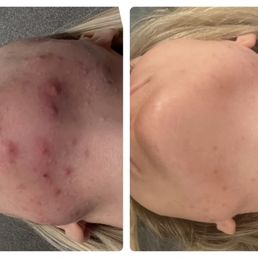 Acne gone in 1 month