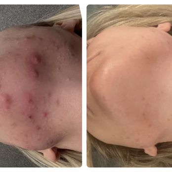 Acne Solutions Skin Care & Spa - Acne gone in 1 month - Acne Treatment Near Me - Upland, California