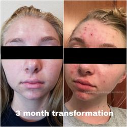 San Diego Skin And Acne Specialist - 3 month before and after photo of client receiving acne treatments and using proper at home care customized for her skin.