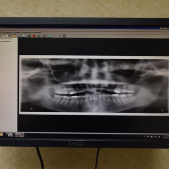 Albern L Spoolstra, DDS - 3/16/18 - My lower left wisdom tooth was chipped. My Dentist referred me to Dr. Spoolstra for double left wisdom teeth extractions. - Oral Surgeons Near Me - Long Beach, California Albern L Spoolstra, DDS - 3/16/18 - My lower left wisdom tooth was chipped. My Dentist referred me to Dr. Spoolstra for double left wisdom teeth extractions. - Oral Surgeons Near Me - Long Beach, California