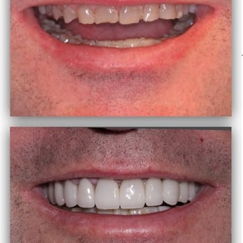 J Timothy Modic, DDS - Worn dentition can have its effects on your smile. We have much to offer when it comes to restoring your smile! - Cosmetic Dentists Near Me