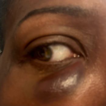 Dream Boutique - My lower eye hematoma. My nail was bent back and I was scratched in my face but I don't feel comfortable exposing too much - Bookstores Near Me - Philadelphia, Pennsylvania Dream Boutique - My lower eye hematoma. My nail was bent back and I was scratched in my face but I don't feel comfortable exposing too much - Bookstores Near Me - Philadelphia, Pennsylvania