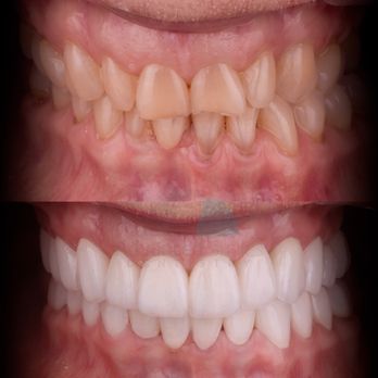Advanced Smiles Dentistry - full mouth emax and zirconia crowns.

Best quality at affordable prices only at advaned smiles dentistry tijuana - Oral Surgeons Near Me - Tijuana, BCN