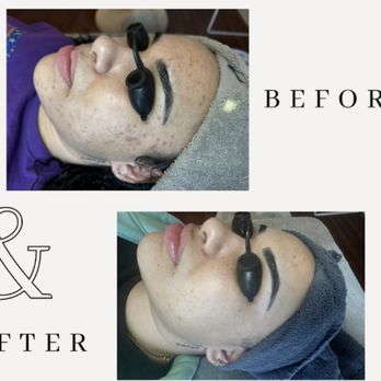 Amy Earnest Acne Specialist - Skin Care Near Me - Oakland, California Amy Earnest Acne Specialist - Skin Care Near Me - Oakland, California