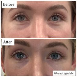PRF undereyes