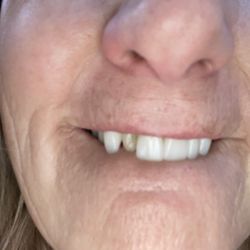 Michael J. Watson DDS - Several veneers repeatedly came off within the first 30 days.
