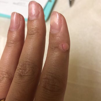Amy's Skincare and MedSpa - Wart - Skin Care Near Me - Houston, Texas