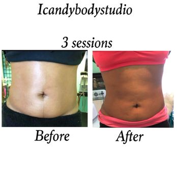 Icandy Body Studio - Get a package of 3 fat Reductions and save on our amazing services! - Body Contouring Near Me - Reynoldsburg, Ohio Icandy Body Studio - Get a package of 3 fat Reductions and save on our amazing services! - Body Contouring Near Me - Reynoldsburg, Ohio