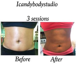 Icandy Body Studio - Get a package of 3 fat Reductions and save on our amazing services!