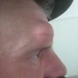 Center For Facial Appearances - Lipoma removal my primary care physician will send you a referral for the removal for this!.