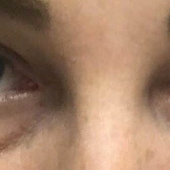 Optimal Health & Wellness - Eye bags almost EVERY single day. - Naturopathic/Holistic Near Me - Pasadena, California Optimal Health & Wellness - Eye bags almost EVERY single day. - Naturopathic/Holistic Near Me - Pasadena, California