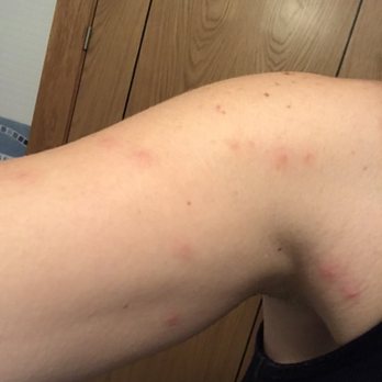 AC Hotel by Marriott Carlton Madrid - BED BUGS - bites on other arm after stay at AC Hotel Carlton Madrid. - Hotels Near Me - Madrid, M