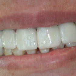Precious Smiles - After 6 Veneers-Dentistry by Dr. Kaocharoen