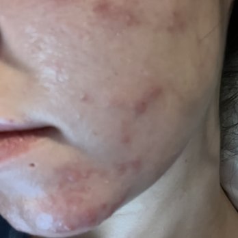7 Day Spa - Post extraction inflammation. Unsanitary and poorly done - Massage Near Me - London, XGL