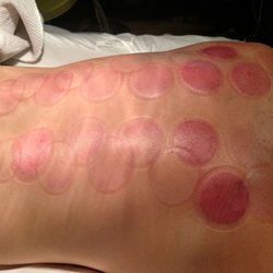 Bao's Healing Center - After the procedure areas of my lungs showed up very red and I still had bronchitis: (