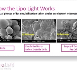 Skinny by Gwen, LLC - Lipolight melts fat
