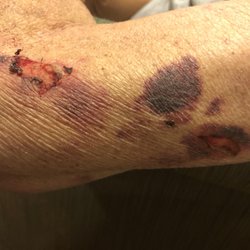 Brookdale Cleveland Park - Untreated injuries