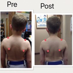 Carmichael Spinal Care - 6 year-old with bad posture but no symptoms. Before and after his first chiropractic treatment.