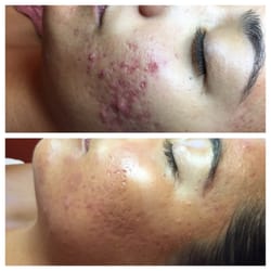 Body Celebration - Holistic Skincare & Wellness - Before and after pic of client with acne.