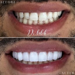 Before and after of my teeth Before and after of my teeth