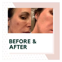 The Skin Bar Miami - Chemical peel