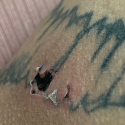 Noor Aesthetics - 3rd degree burn from laser hair removal!!!
