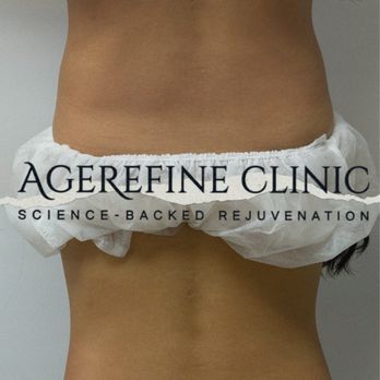 AgeRefine Clinic - One ONDA Pro treatment for the abdomen and flanks. A more defined waistline, smoother body contours, and noticeable improvement - Medical Spas Near Me - Irvine, California AgeRefine Clinic - One ONDA Pro treatment for the abdomen and flanks. A more defined waistline, smoother body contours, and noticeable improvement - Medical Spas Near Me - Irvine, California