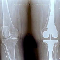 Robert E Holmes, MD - Femur notched thigh & calf-Unauthorized procedure & not advised due to future complications; see for yourself the bone size between legs.