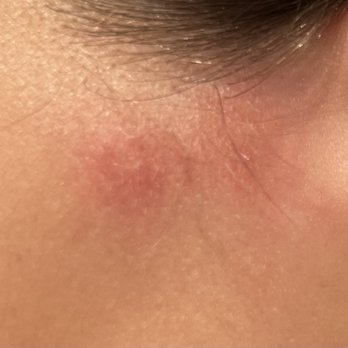 Woodbridge Gardens Apartments - More bug bites - Apartments Near Me - Lake, California