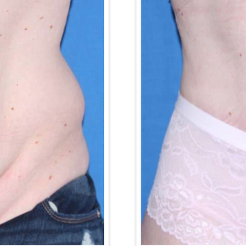 Iconic Plastic Surgery - 35 year old female with abdominal skin excess and fat excess in the flanks. Procedure: Abdominoplasty with rectus muscle plication and lipo - Cosmetic Surgeons Near Me - Carlsbad, California Iconic Plastic Surgery - 35 year old female with abdominal skin excess and fat excess in the flanks. Procedure: Abdominoplasty with rectus muscle plication and lipo - Cosmetic Surgeons Near Me - Carlsbad, California