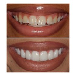 Andre Bruni - Pearl Dental Group - Porcelain Veneers